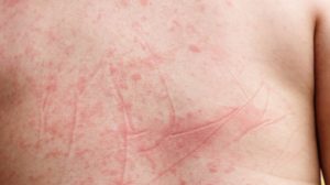 dengue sardegna